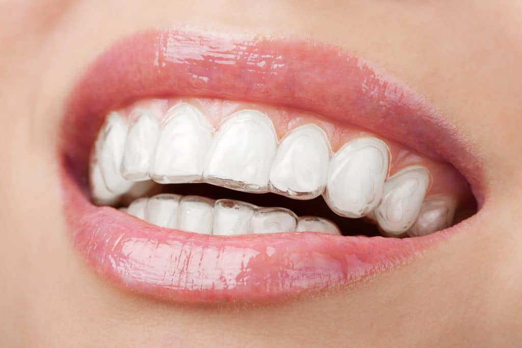 Can You Whiten Your Teeth While Using Invisalign?