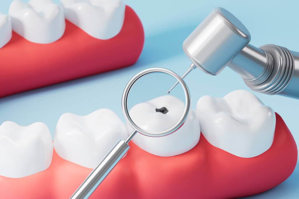 How Curodont Helps Reverse Early Tooth Decay Without Drilling