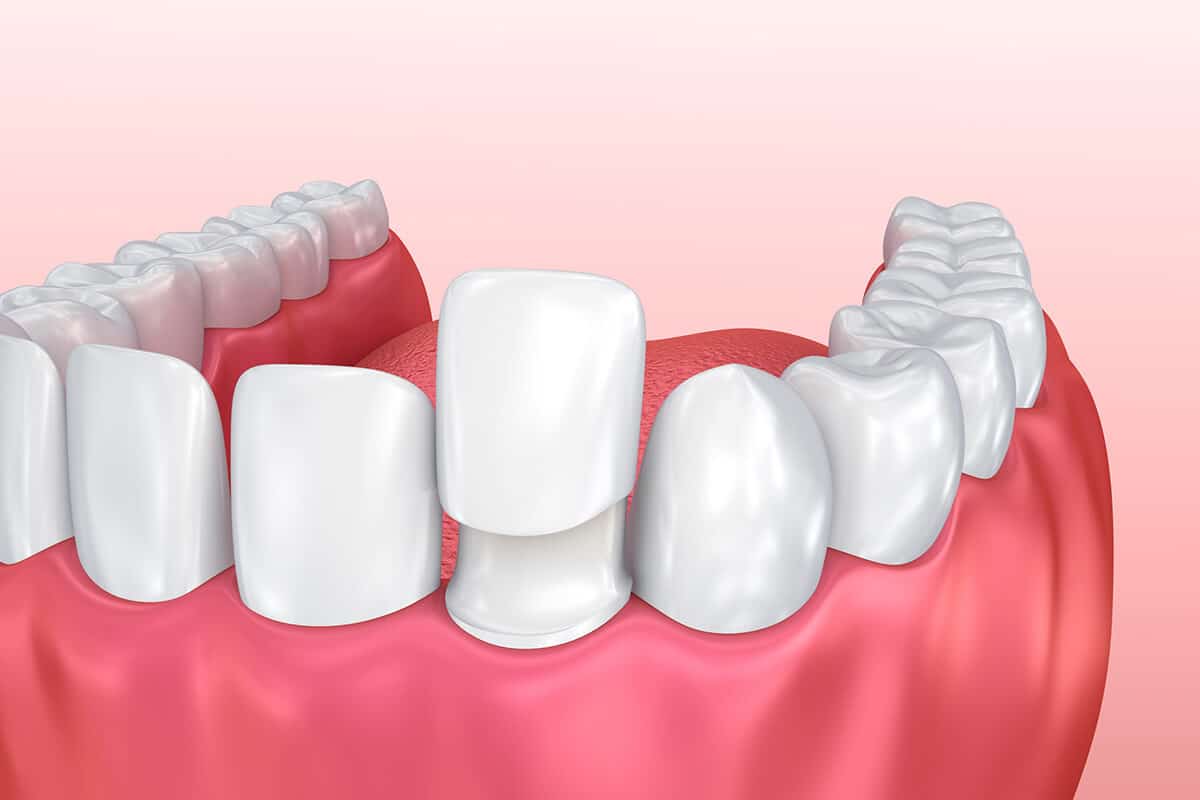 How Do Dental Veneers Work? Imperial Dental Associates