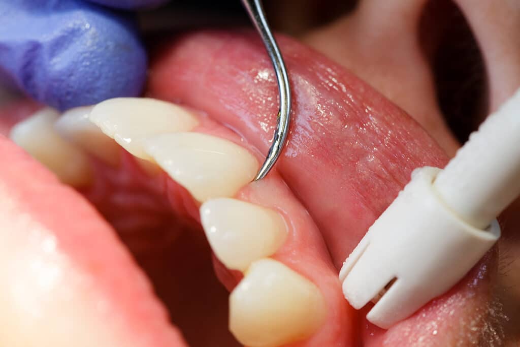 PerioProtect: A Modern Approach to Treating Gum Disease
