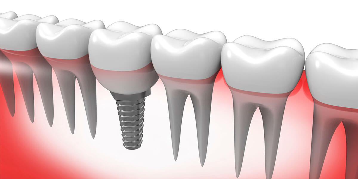Single Dental Implants in Westport, CT
