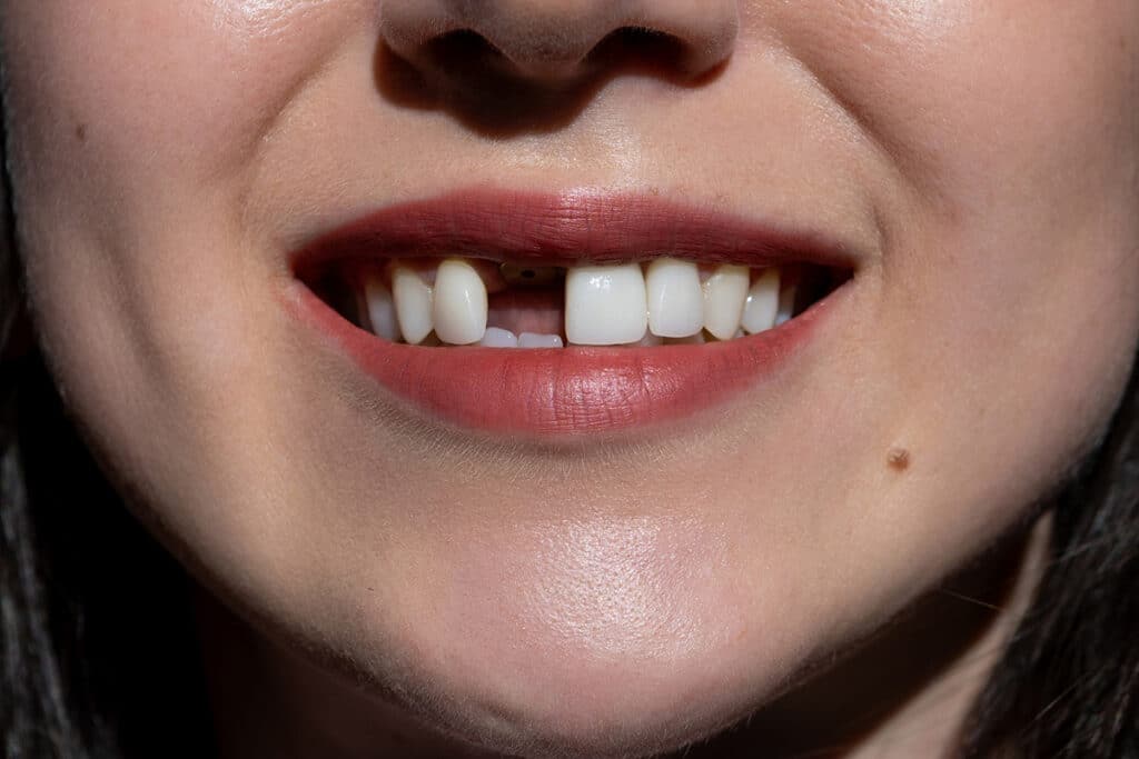 What Happens If You Don’t Replace a Missing Tooth?